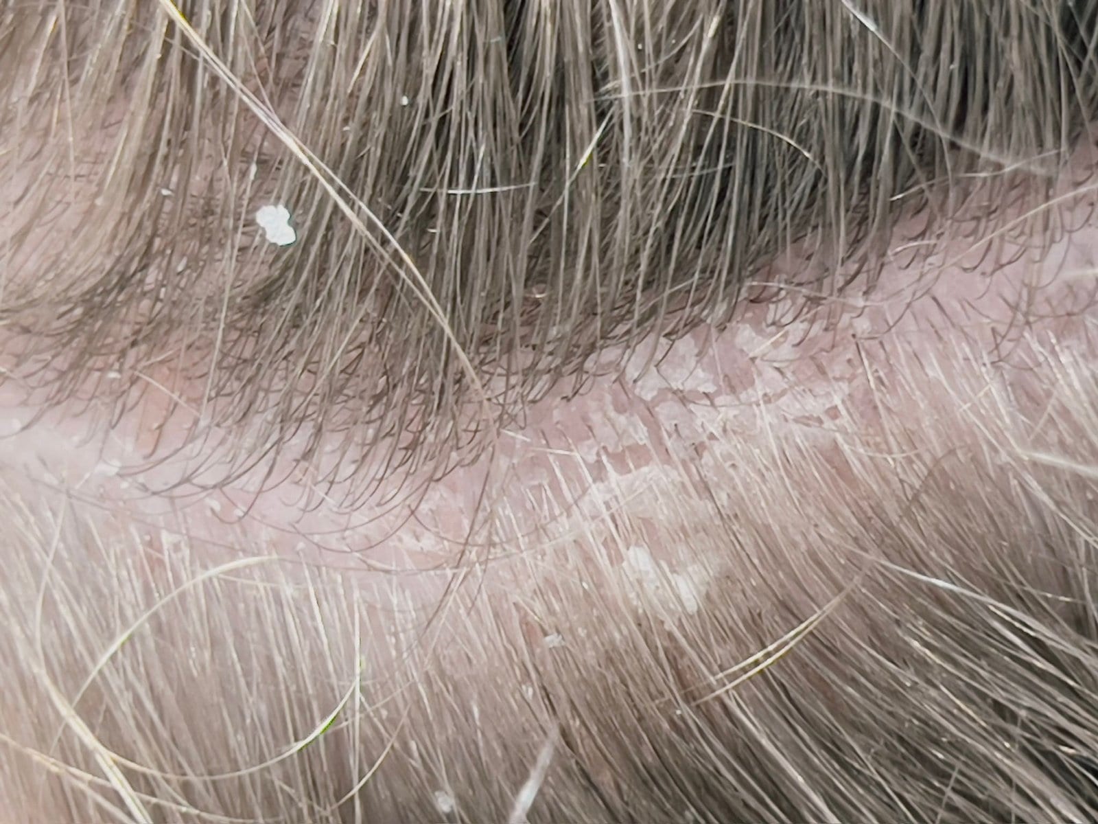 Trichology consultation and scalp analysis at About Hair Mackay, example 3